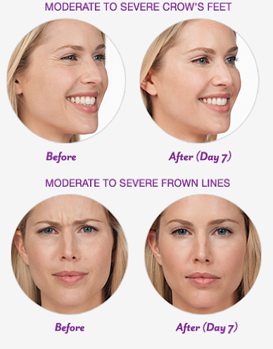 Cape-Cod-Botox-Results