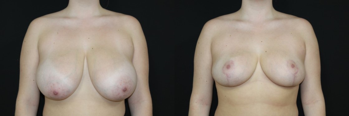 An example of Breast Reduction surgery performed at Cape & Islands Plastic Surgery