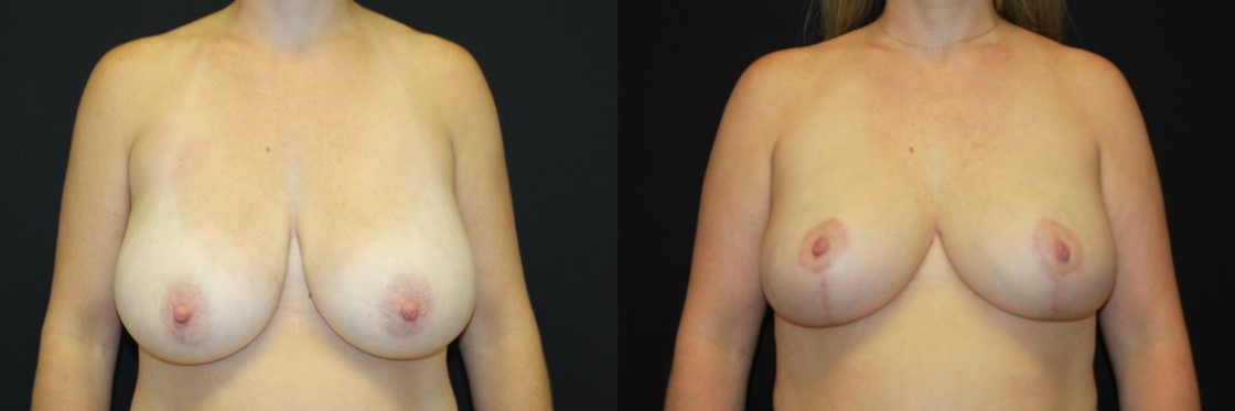 Before and After Images of Breast Reduction Surgery