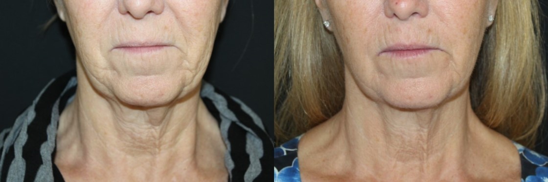 Before & After Images of Profound Facial Rejuvenation