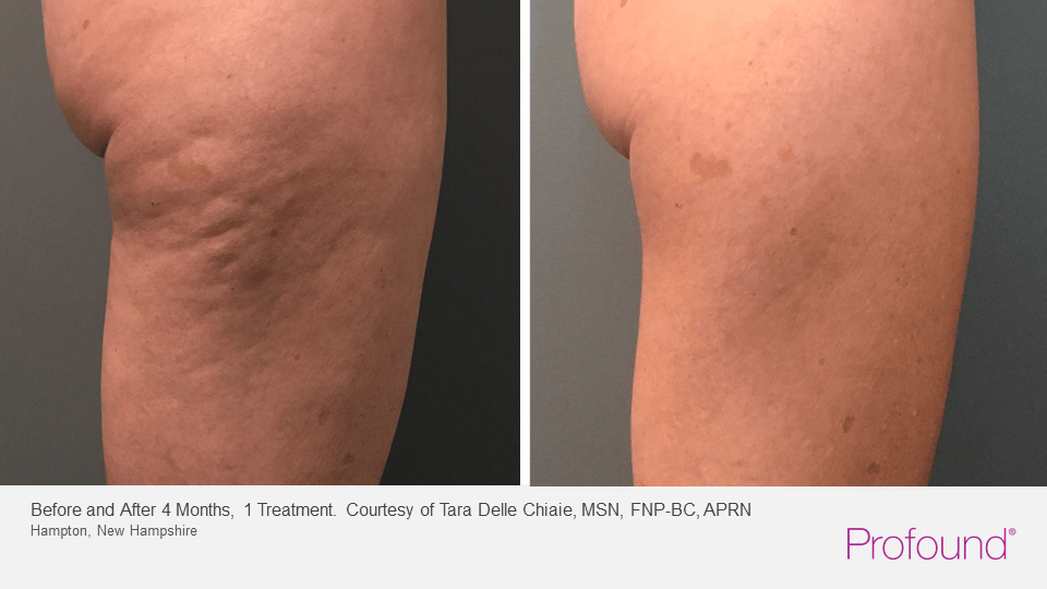 Profound RF Treatment for Outer Thigh to Remove Cellulite