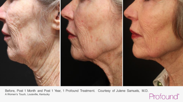 before and after for profound microneedling on the face