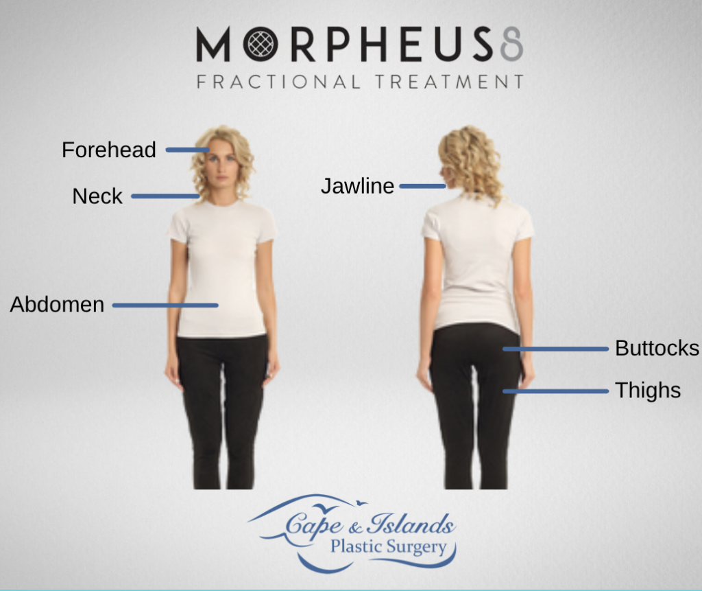morpheus8 treatment areas