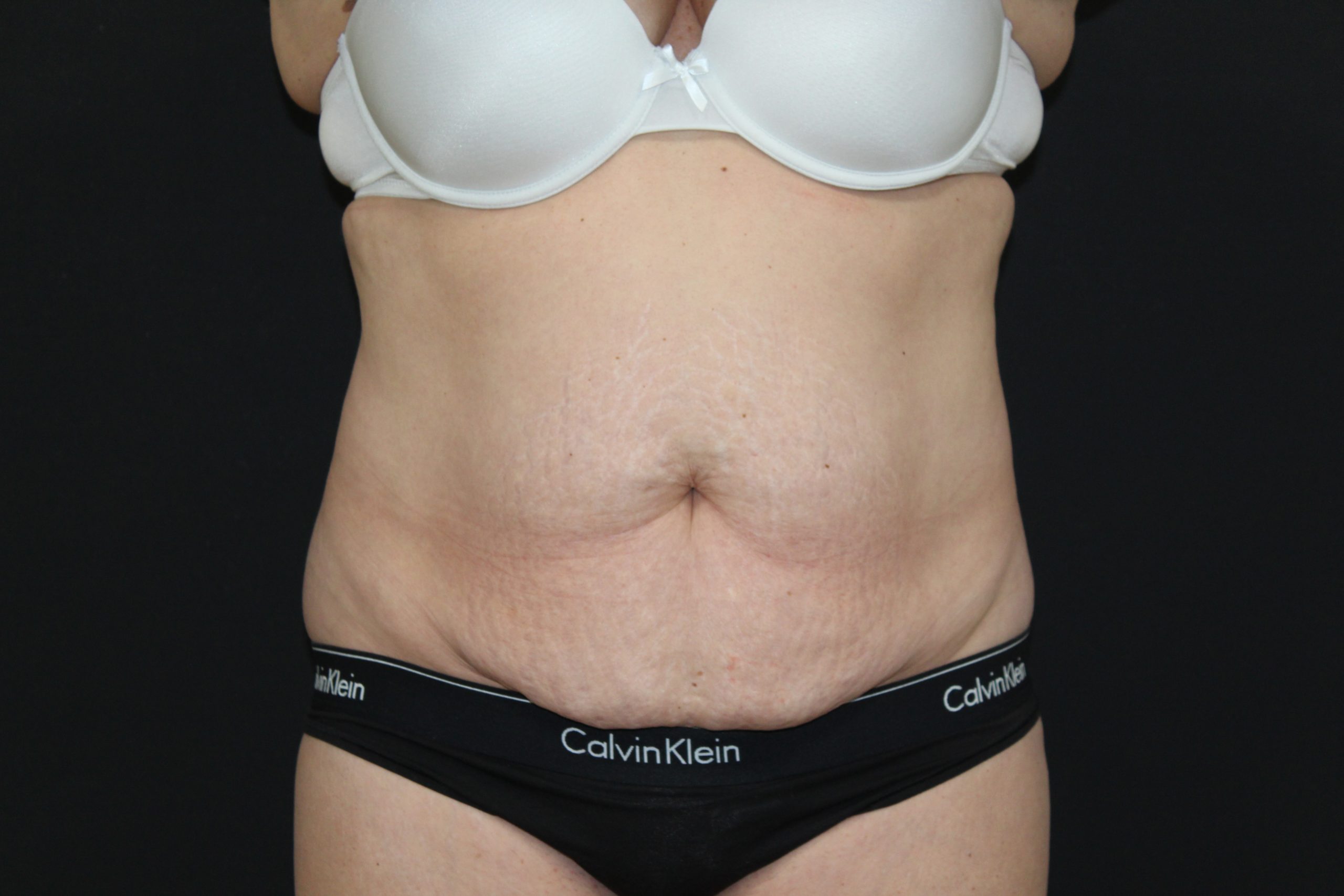 an before image from an abdominoplasty / tummy tuck procedure done by CIPS