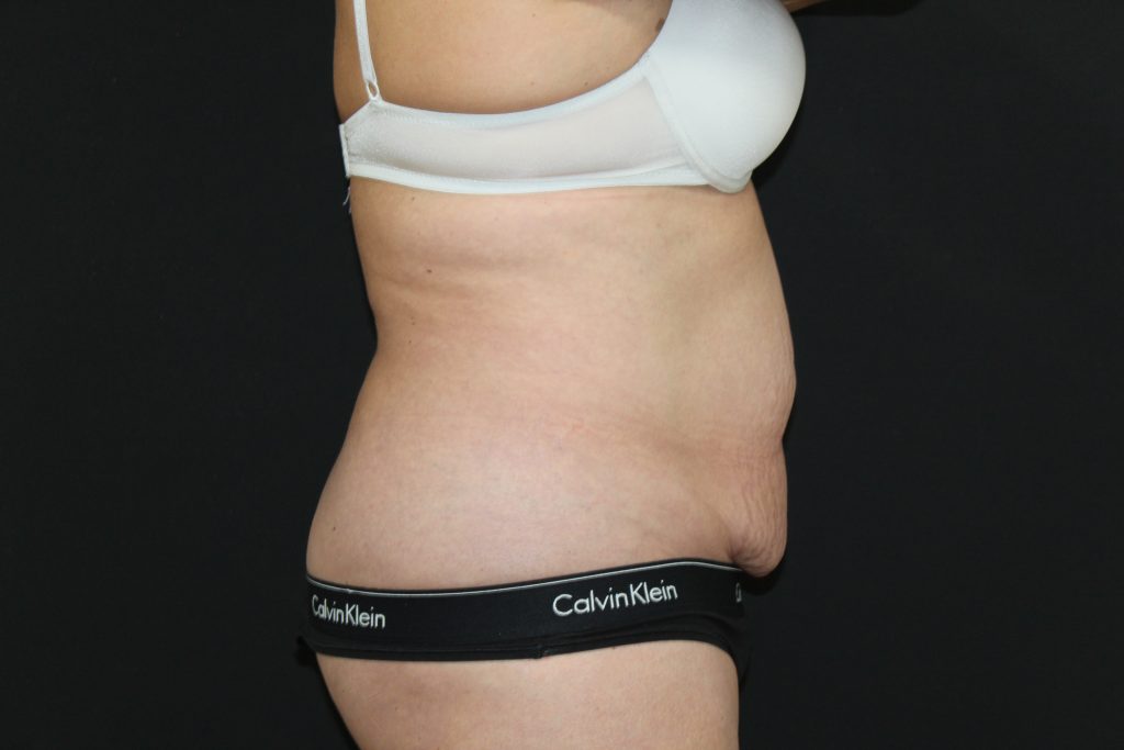 an before image from an abdominoplasty / tummy tuck procedure done by CIPS