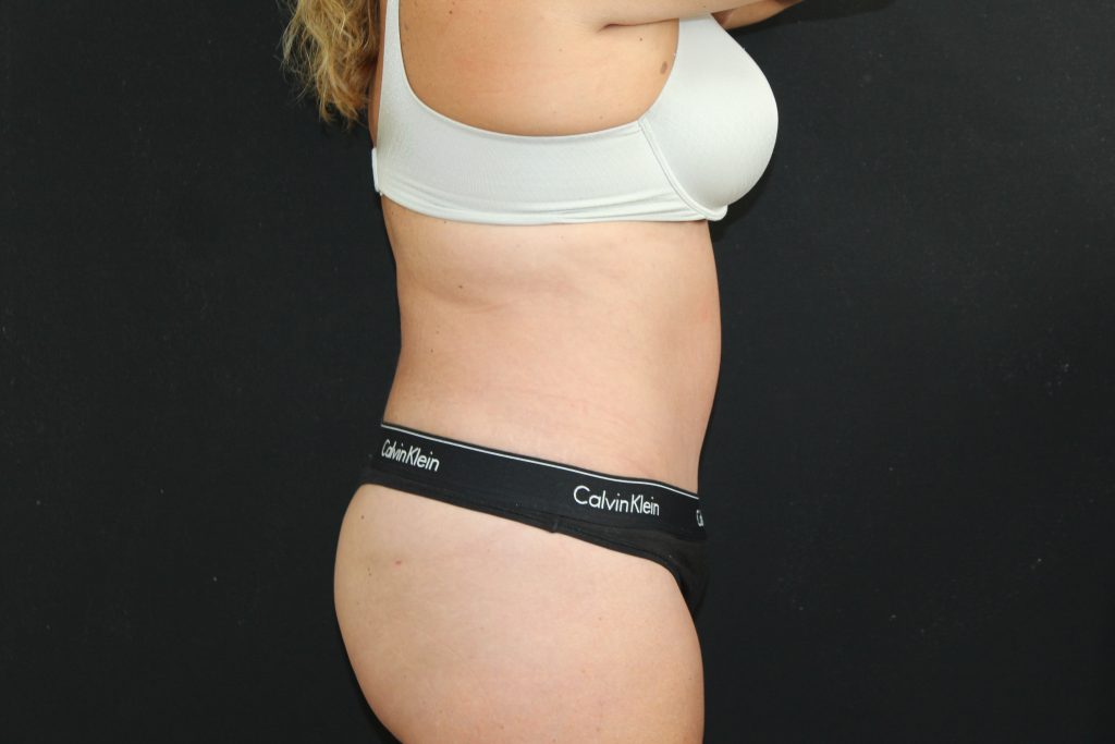 an after image from an abdominoplasty / tummy tuck procedure done by CIPS