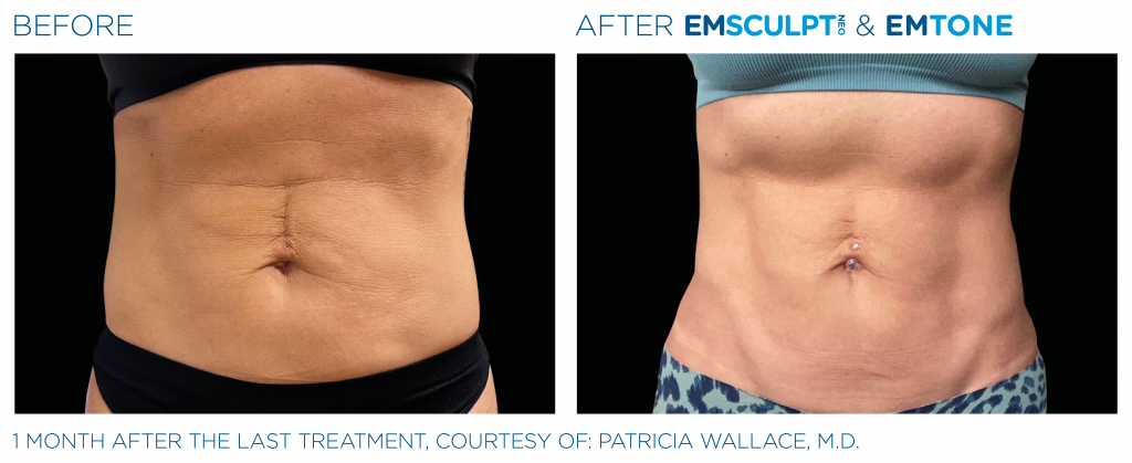 Emsculpting in Cape Cod, Hyannis & Plymouth MA