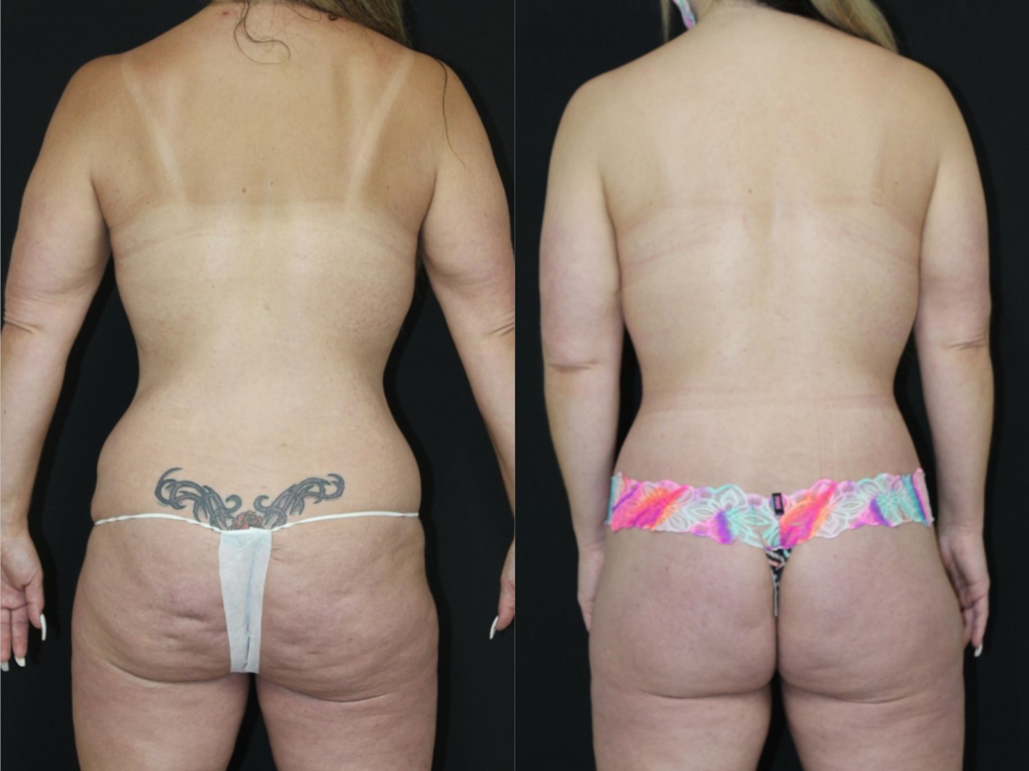 low-commitment procedures for skin laxity after semaglutide How to Fix Ozempic Face Addressing Skin Laxity and Muscle